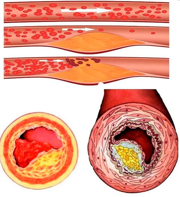 prosztata adenoma artrózisos kezelése